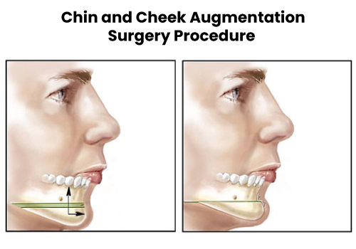 Chin Cheek Surgery Liposuction Treatment In Navi Mumbai