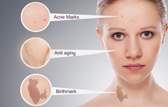 acne marks birthmarks and anti-ageing treatment clinic