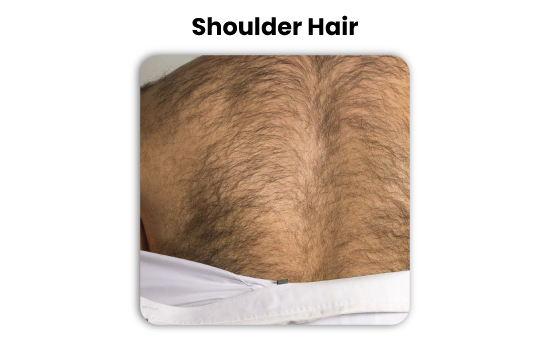 shoulder and body hair transplant