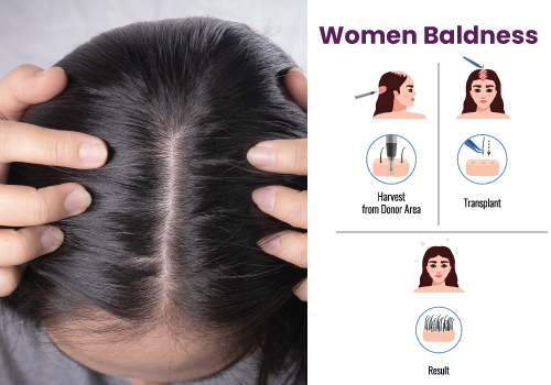Female pattern baldness treatment in navi Mumbai