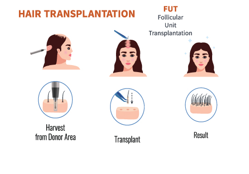 Fut hair transplant surgery