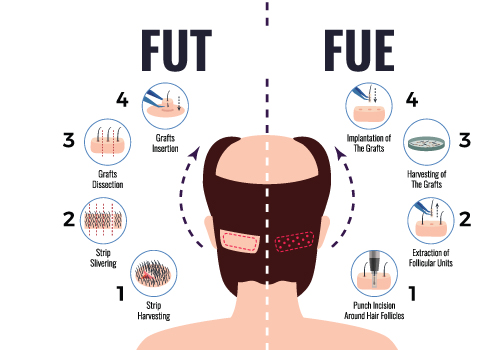 hair transplant innovations and procedures