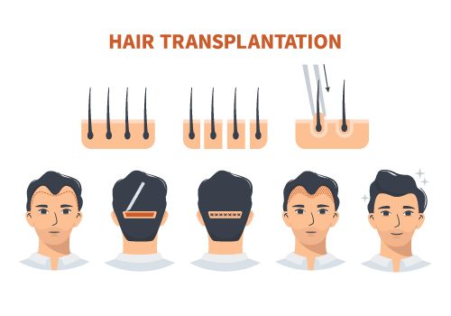hair transplantation recovery
