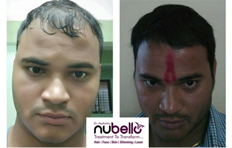 Platelet Rich Plasma or PRP Hair Treatment In Mumbai - Nubello Aesthetics