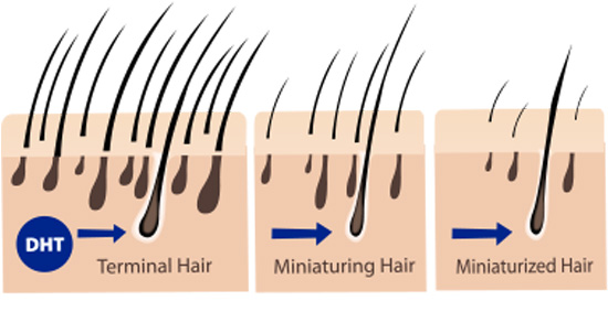 direct hair implantation technique
