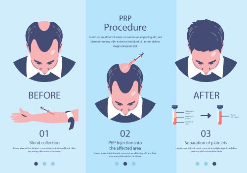 prp procedure infographics