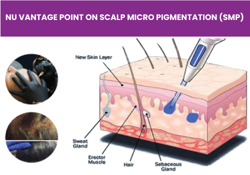 scalp micro pigmentation follicular unit extraction