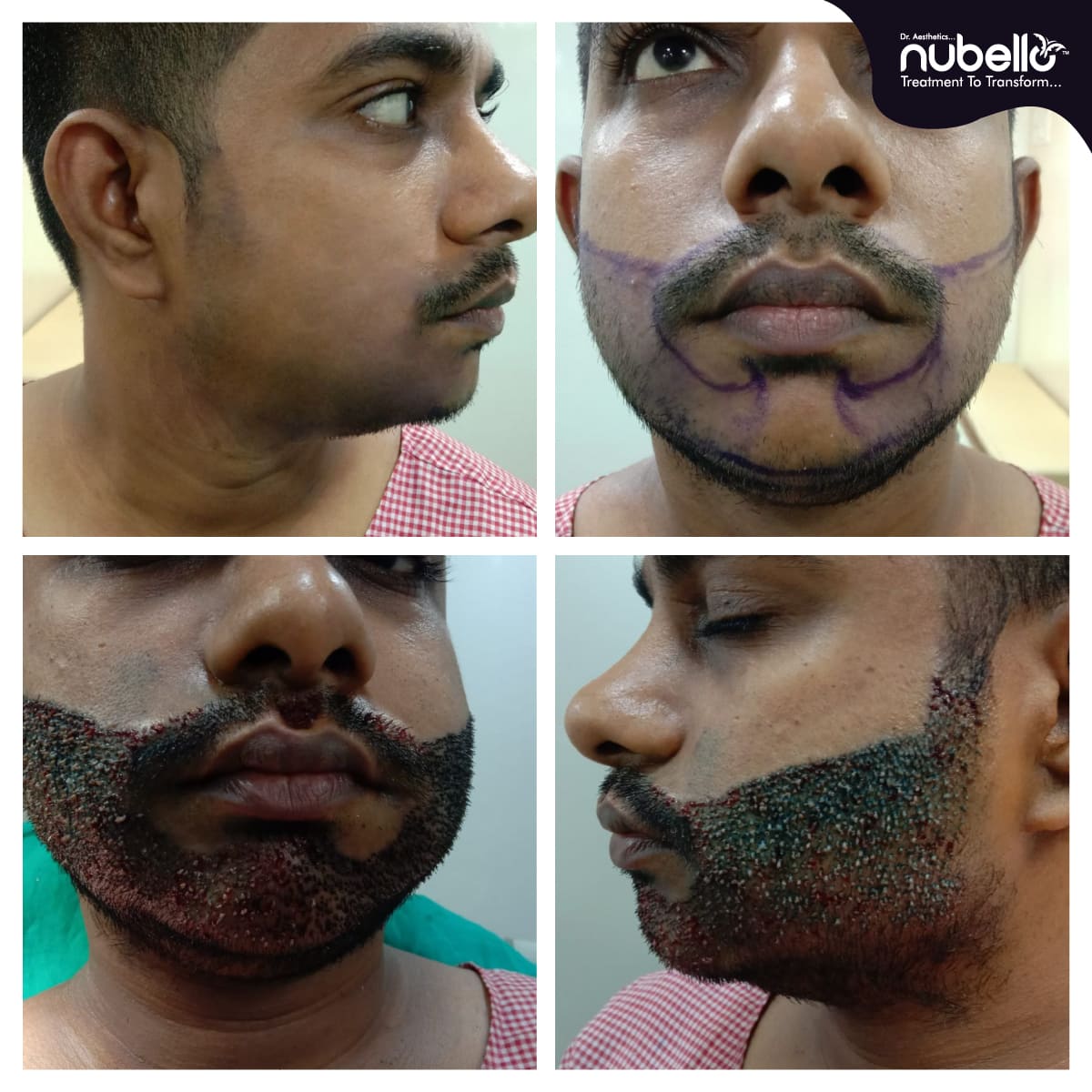 Before Hair Transplant 001