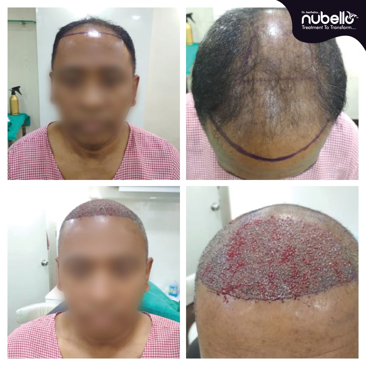 Before Hair Transplant 002