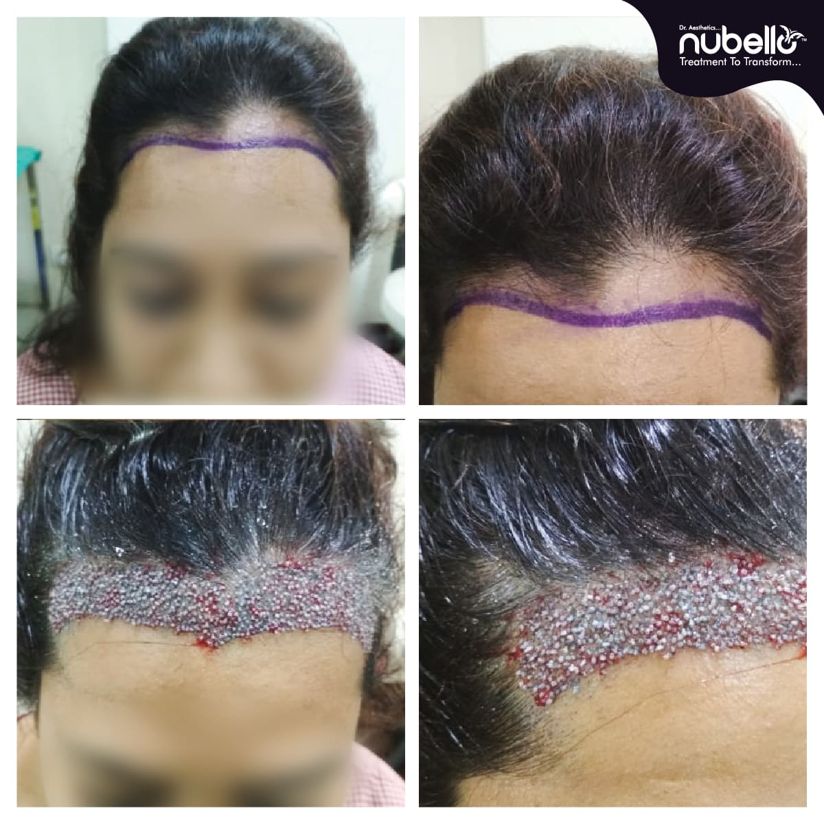 Before Hair Transplant 003