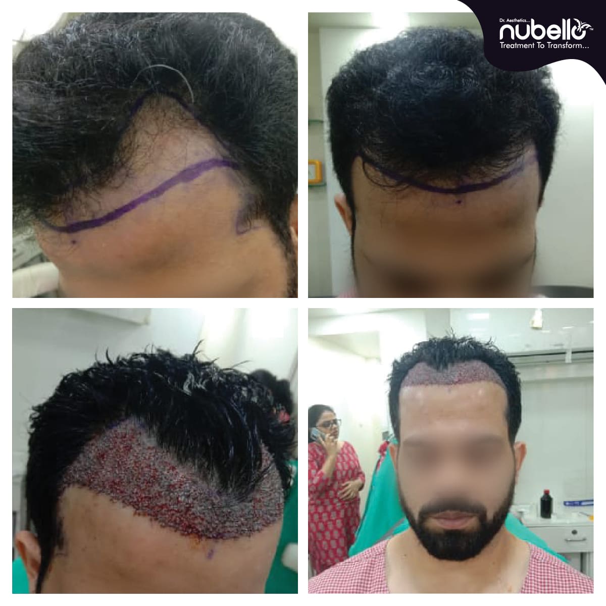 Before Hair Transplant 004