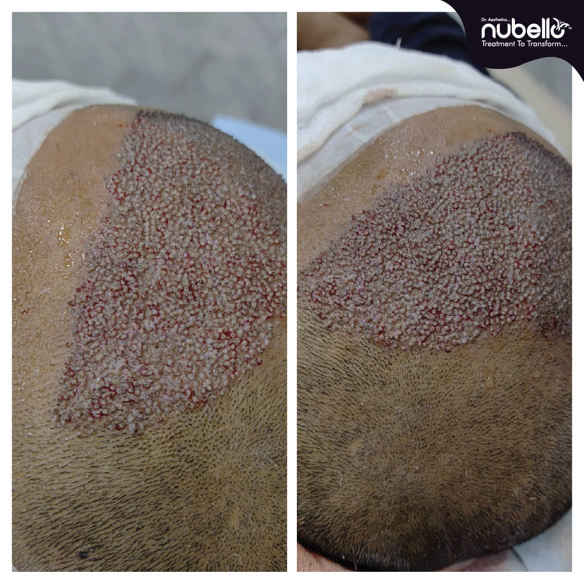 Before Hair Transplant 001