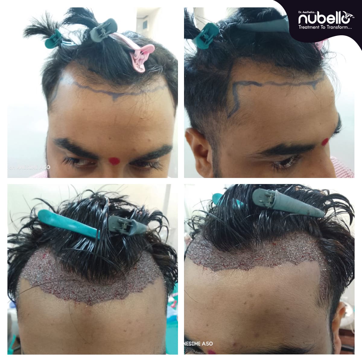 Before Hair Transplant 002