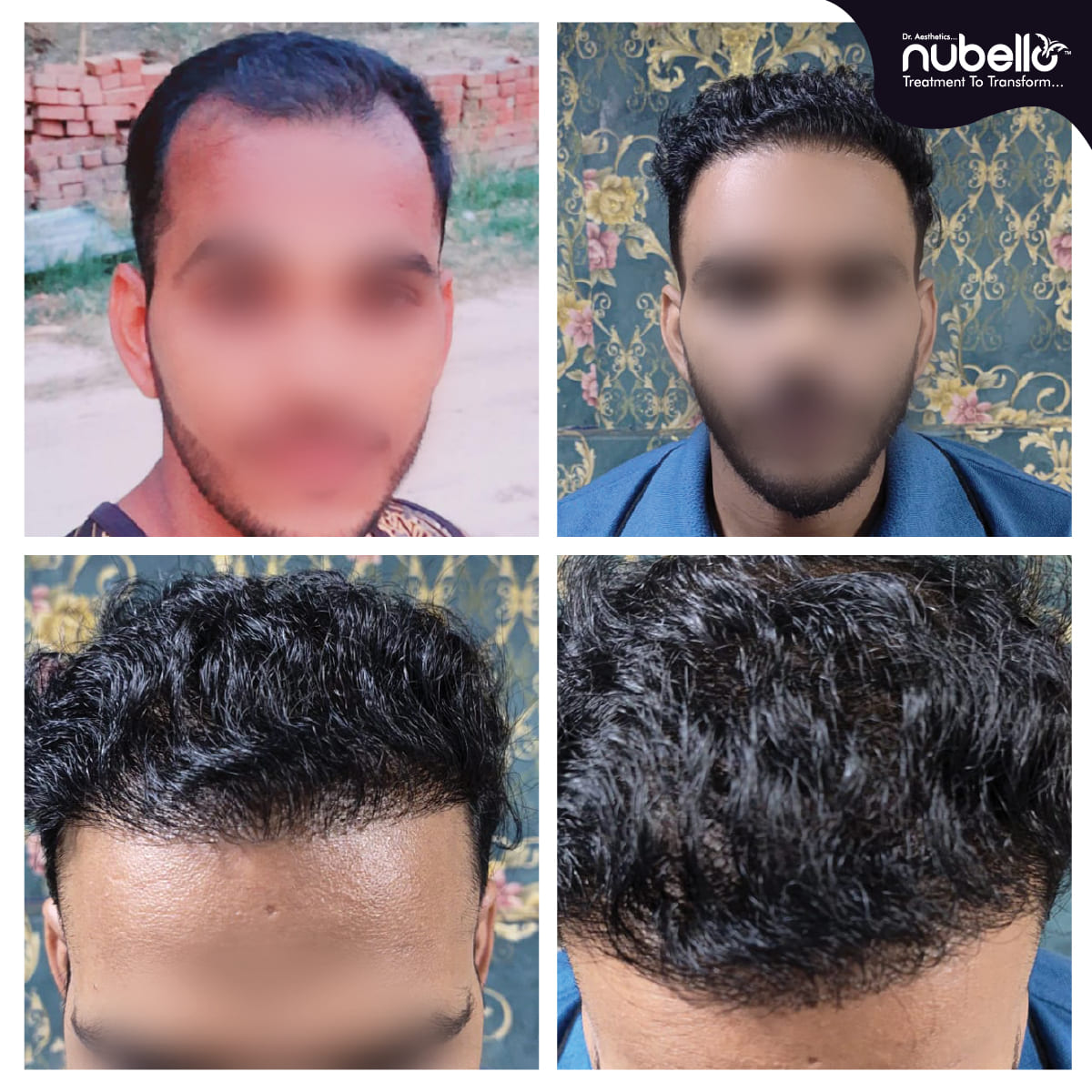 Before Hair Transplant 003