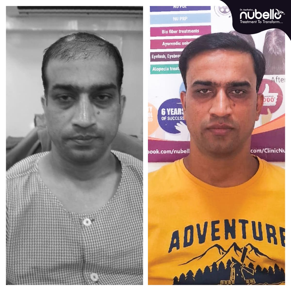 Before Hair Transplant 009