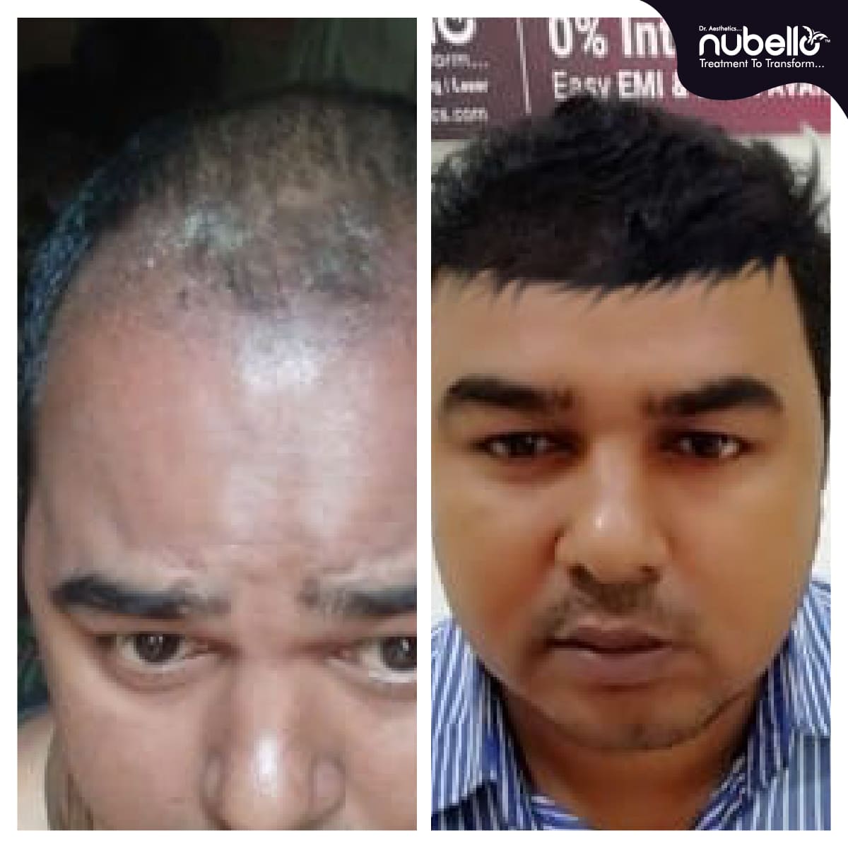 Before Hair Transplant 010