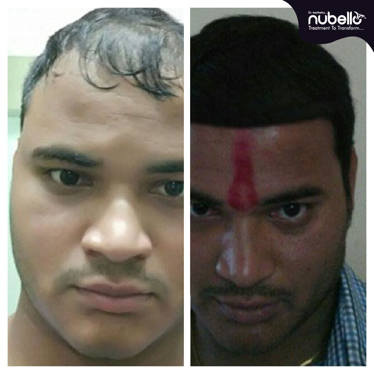Before Hair Transplant 011