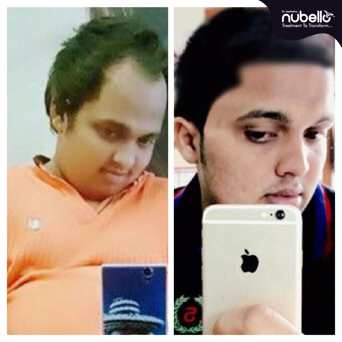 Before Hair Transplant 013