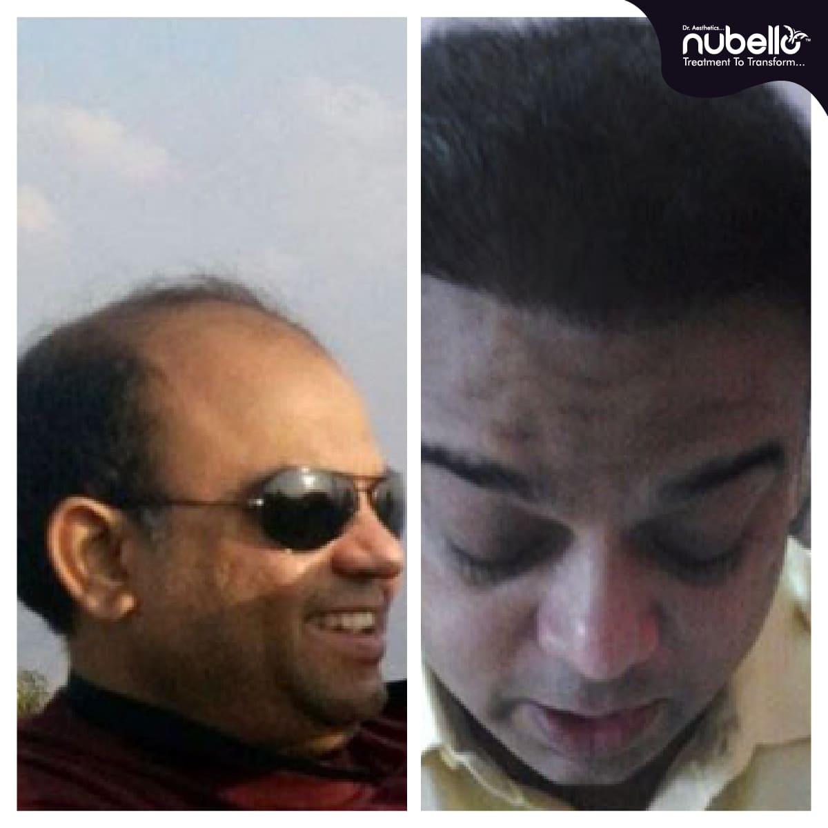 Before Hair Transplant 014