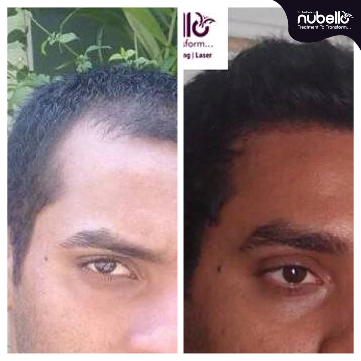 Before Hair Transplant 015