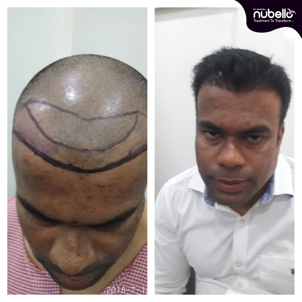 Before Hair Transplant 017