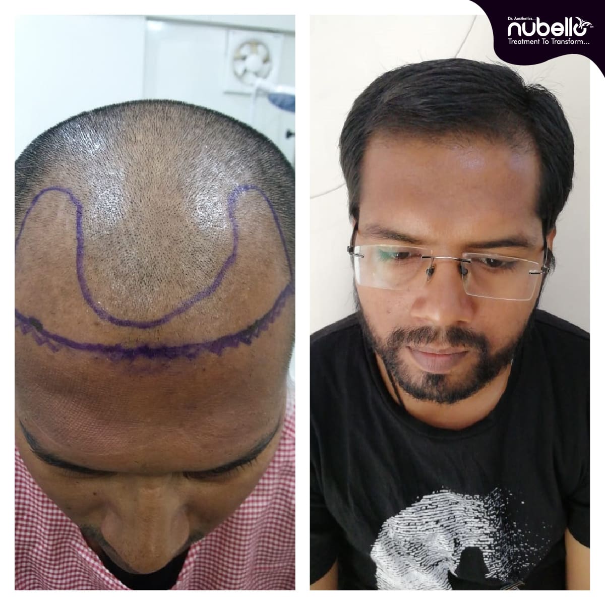 Before Hair Transplant 018
