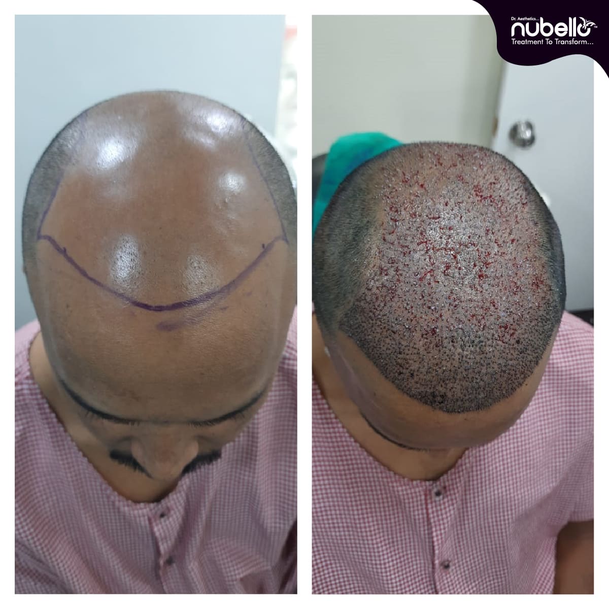 Before Hair Transplant 019