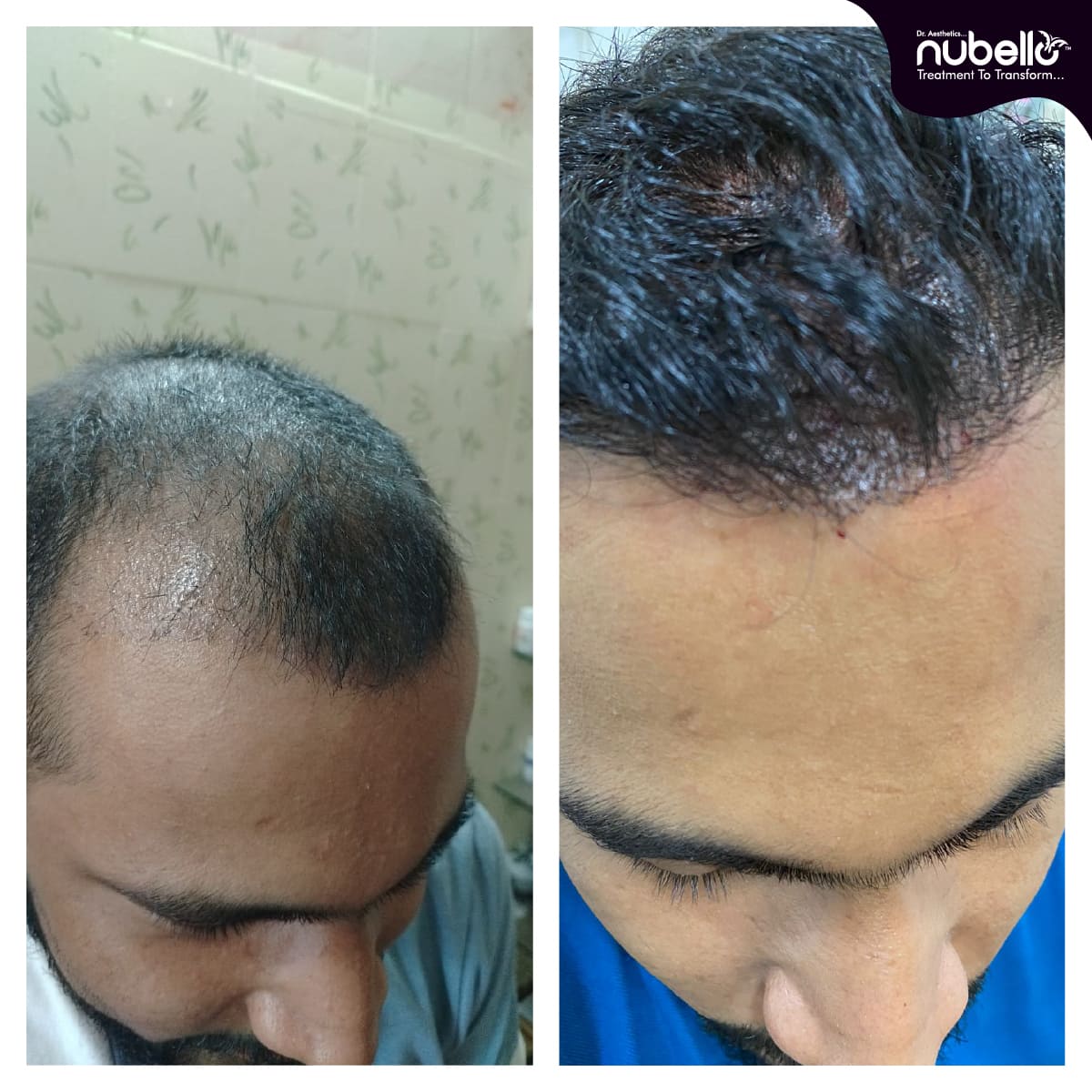 Before Hair Transplant 020