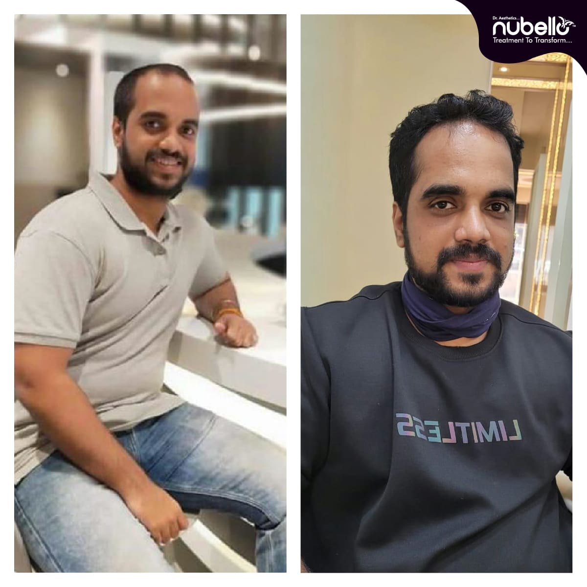 Before Hair Transplant 021