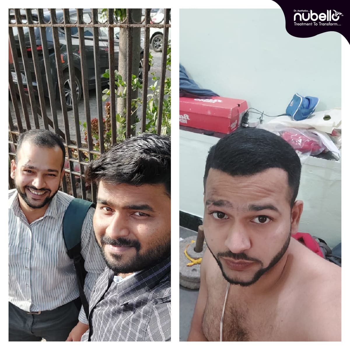 Before Hair Transplant 022