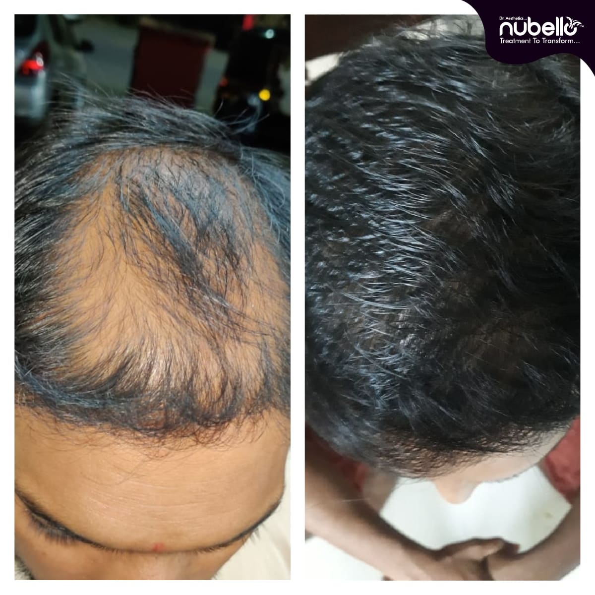 Before Hair Transplant 023