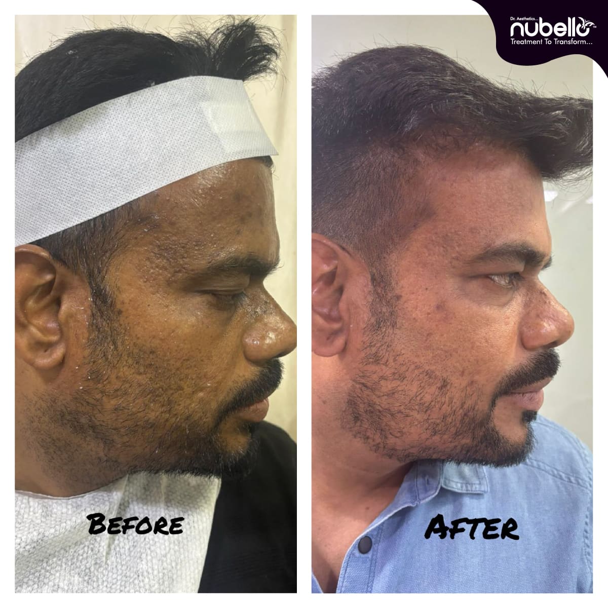 Before Hair Transplant 024