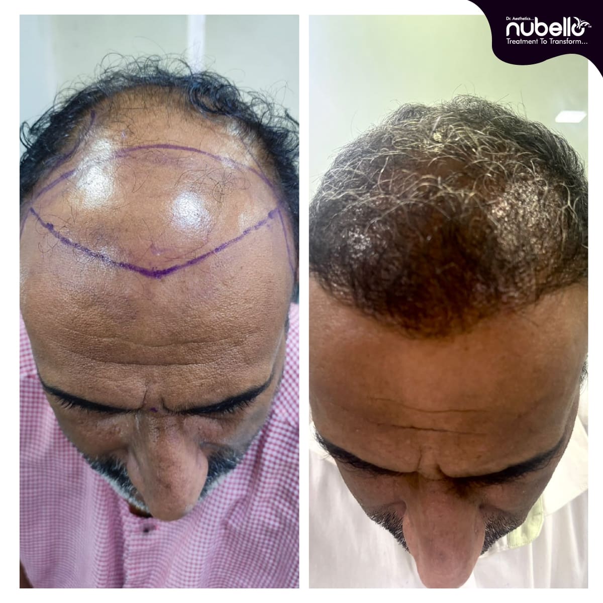 Before Hair Transplant 025