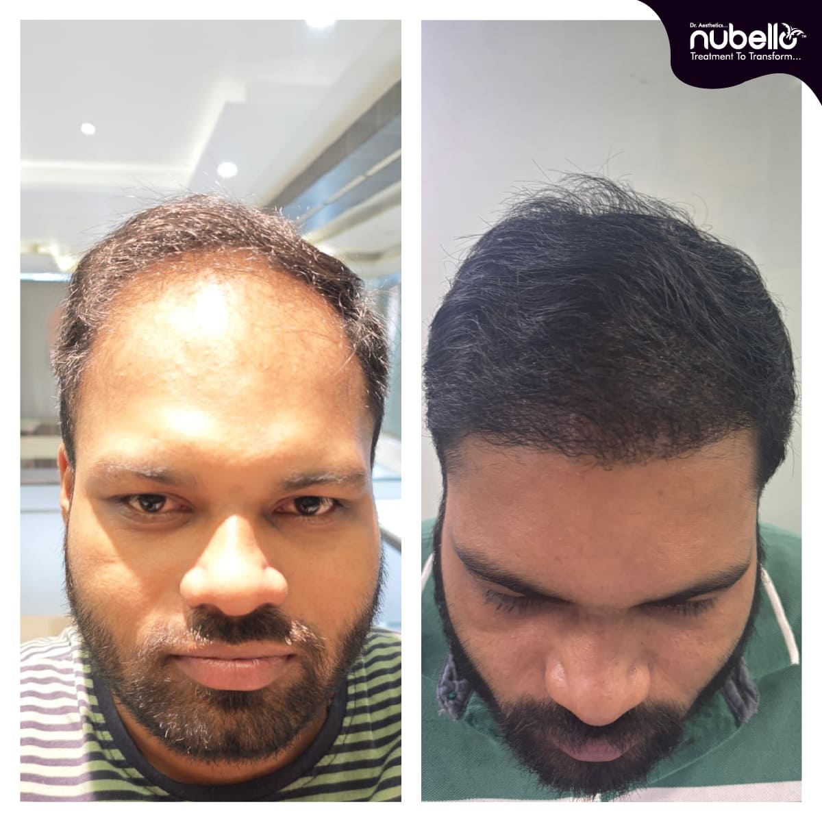 Before Hair Transplant 026