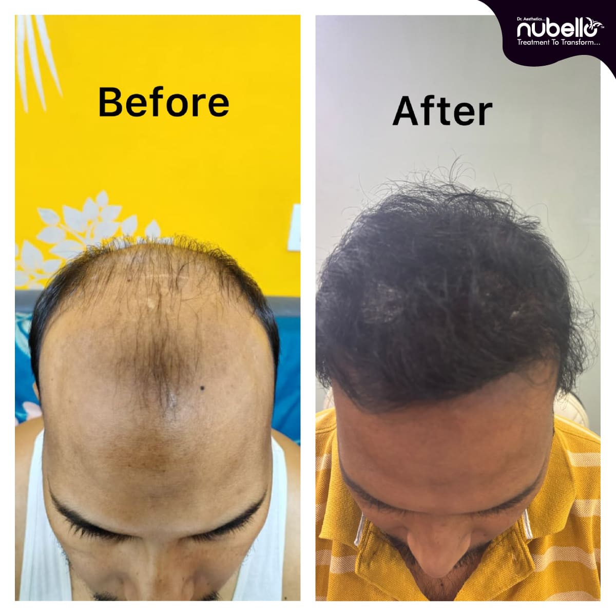 Before Hair Transplant 027