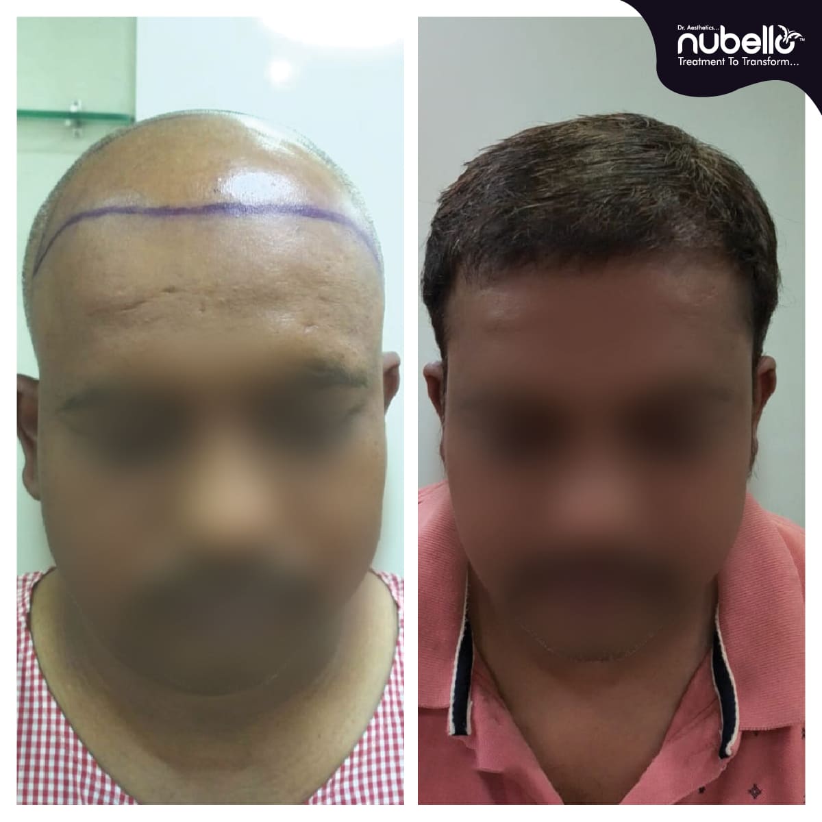 Before Hair Transplant 029