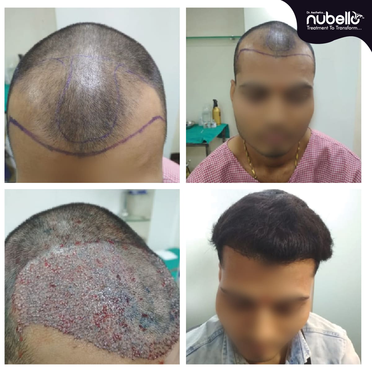 Before Hair Transplant 030