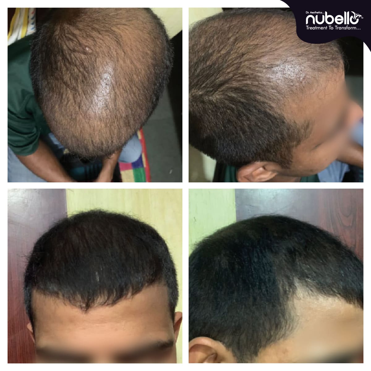 Before Hair Transplant 031