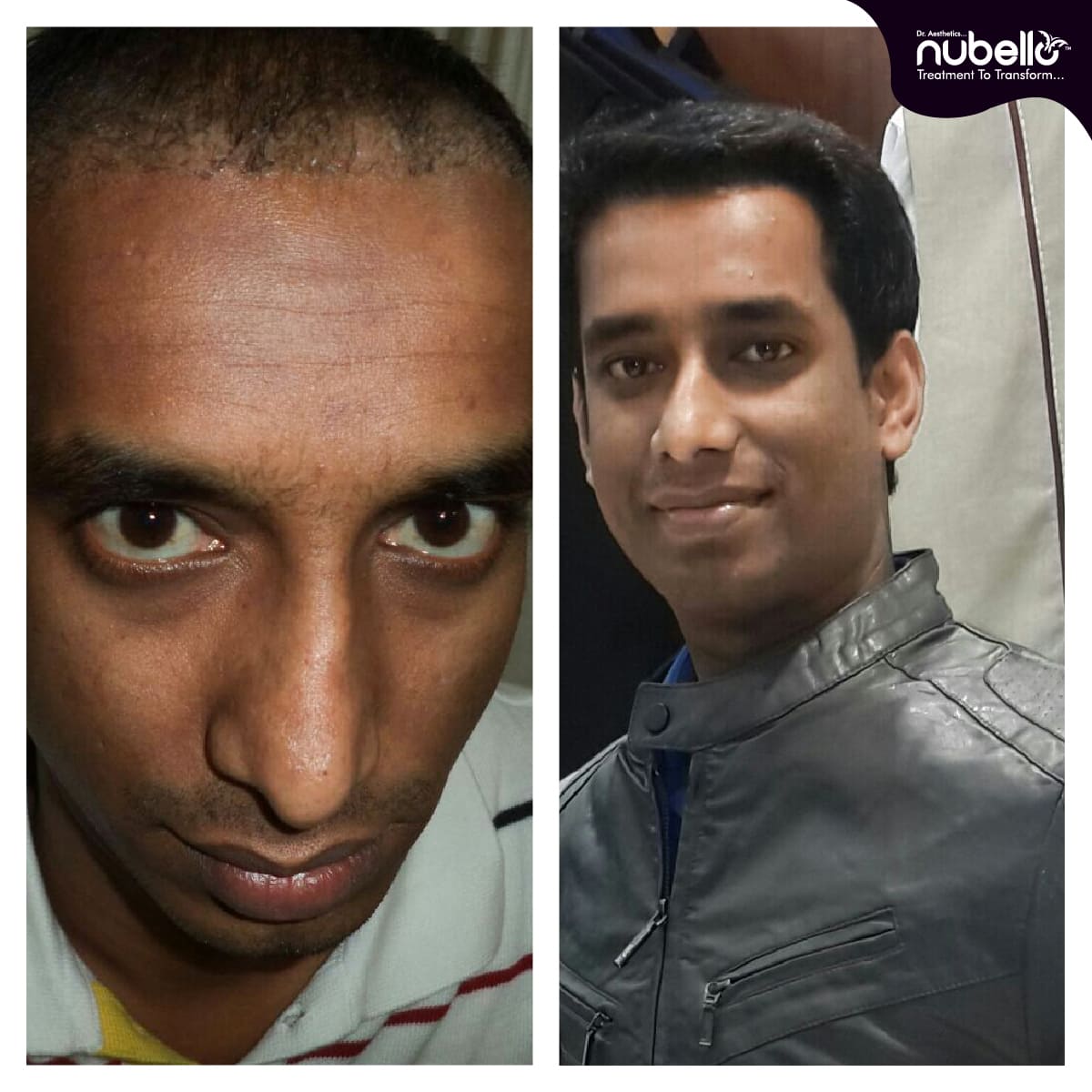 Before Hair Transplant 032