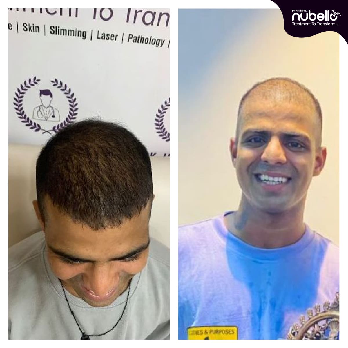 Before Hair Transplant 033
