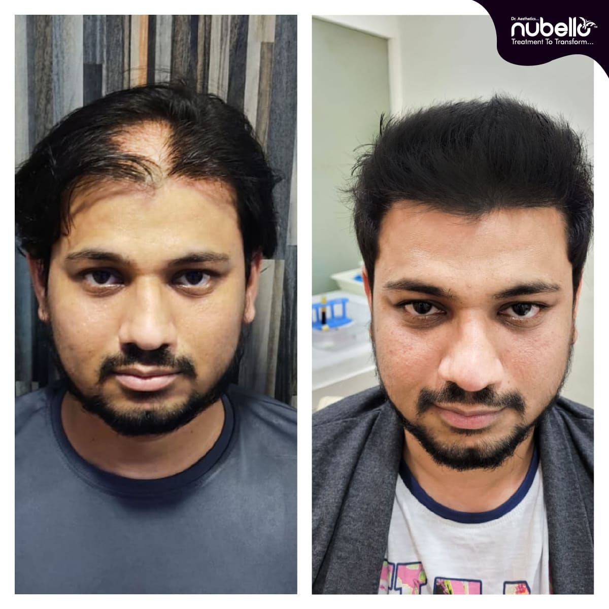 Before Hair Transplant 034