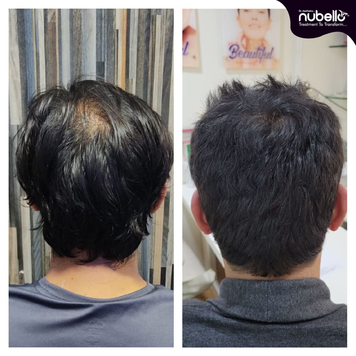 Before Hair Transplant 035