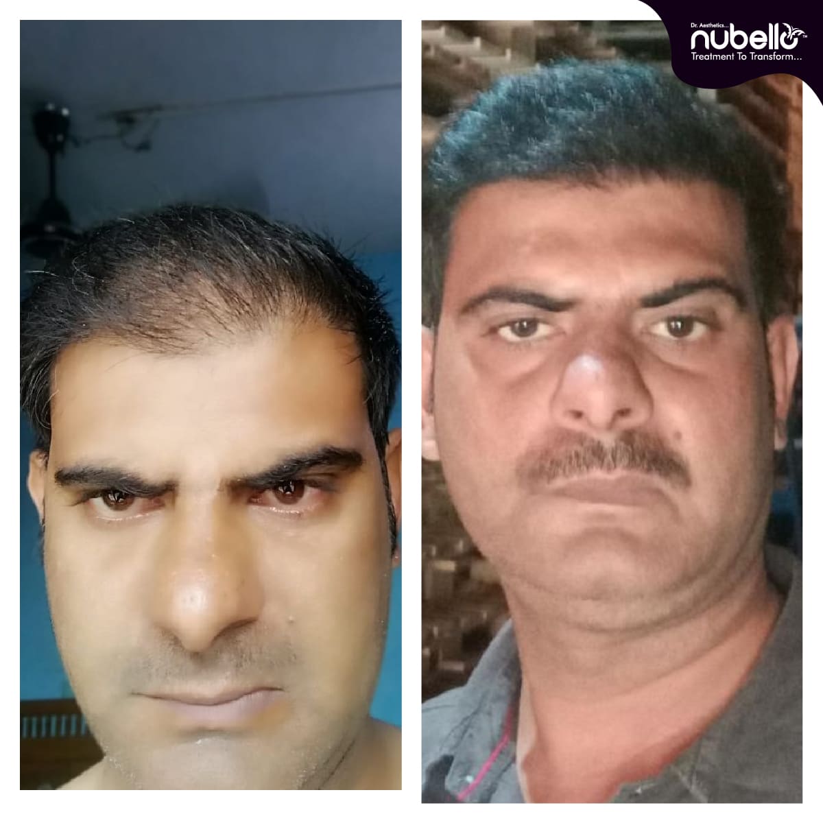 Before Hair Transplant 036