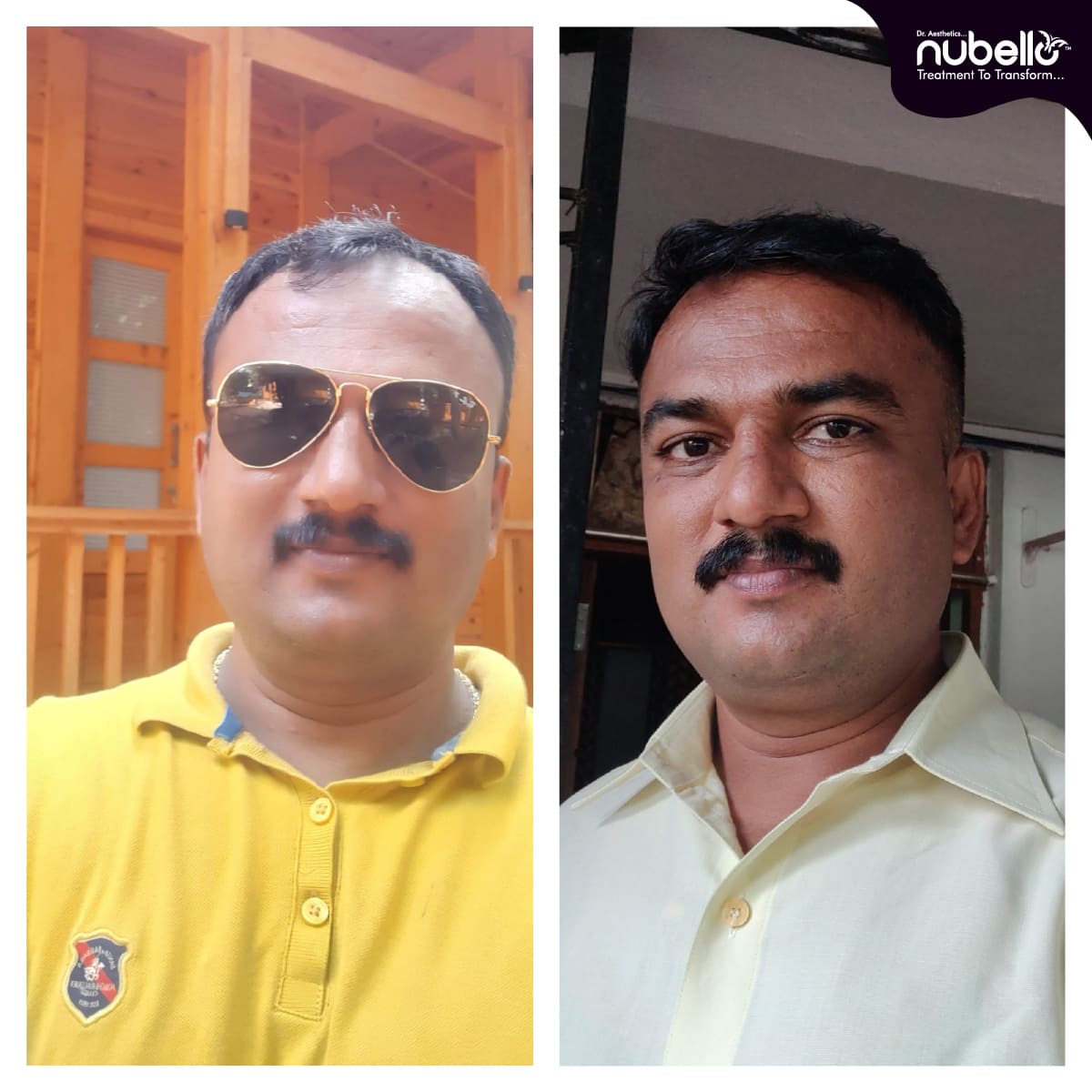 Before Hair Transplant 037