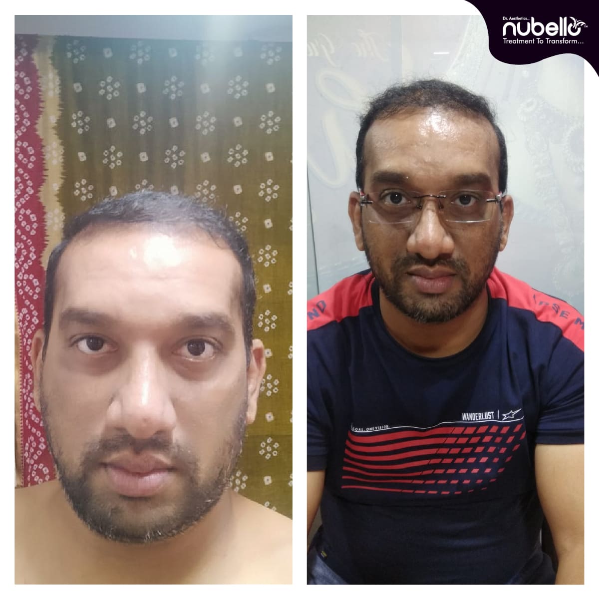 Before Hair Transplant 038