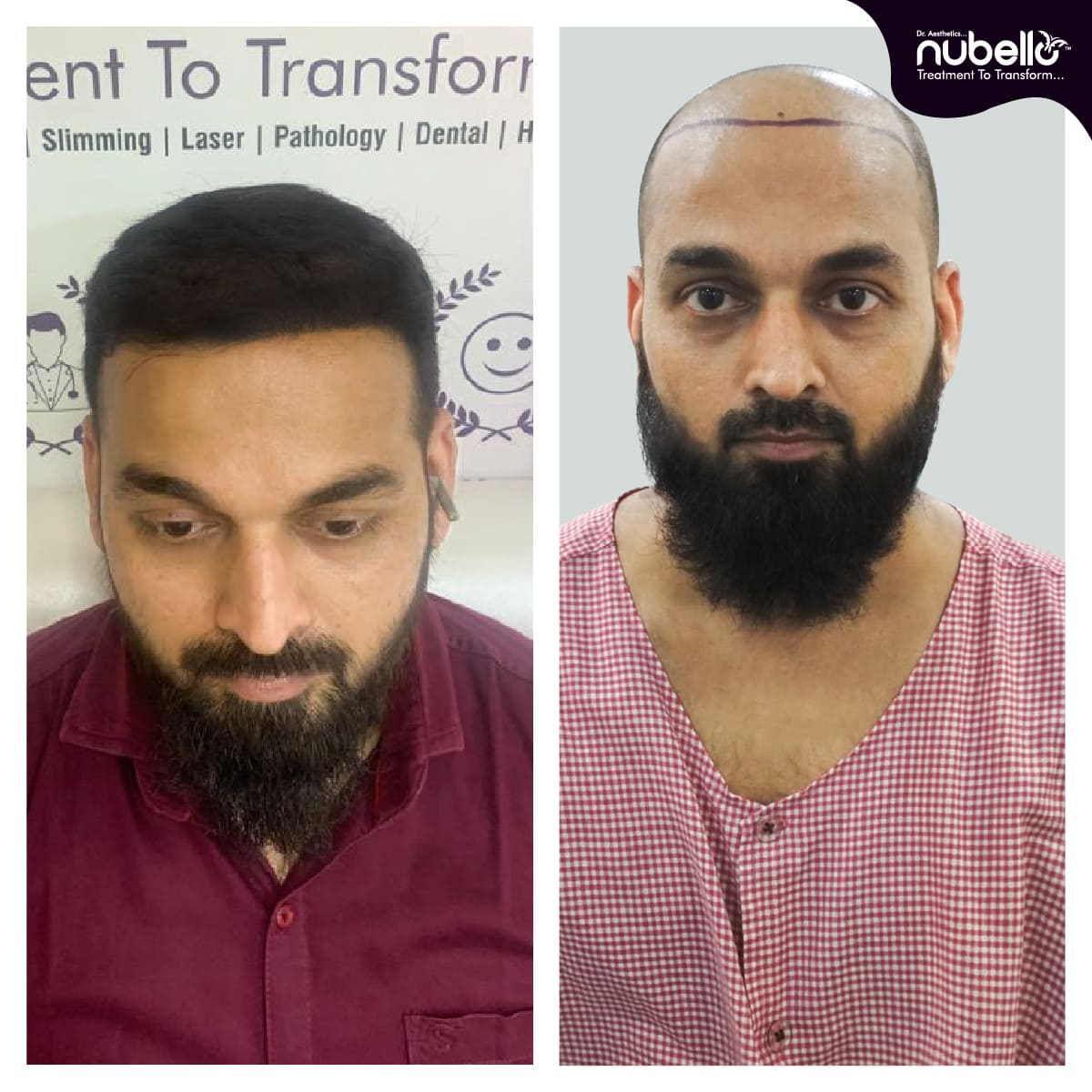 Before Hair Transplant 039