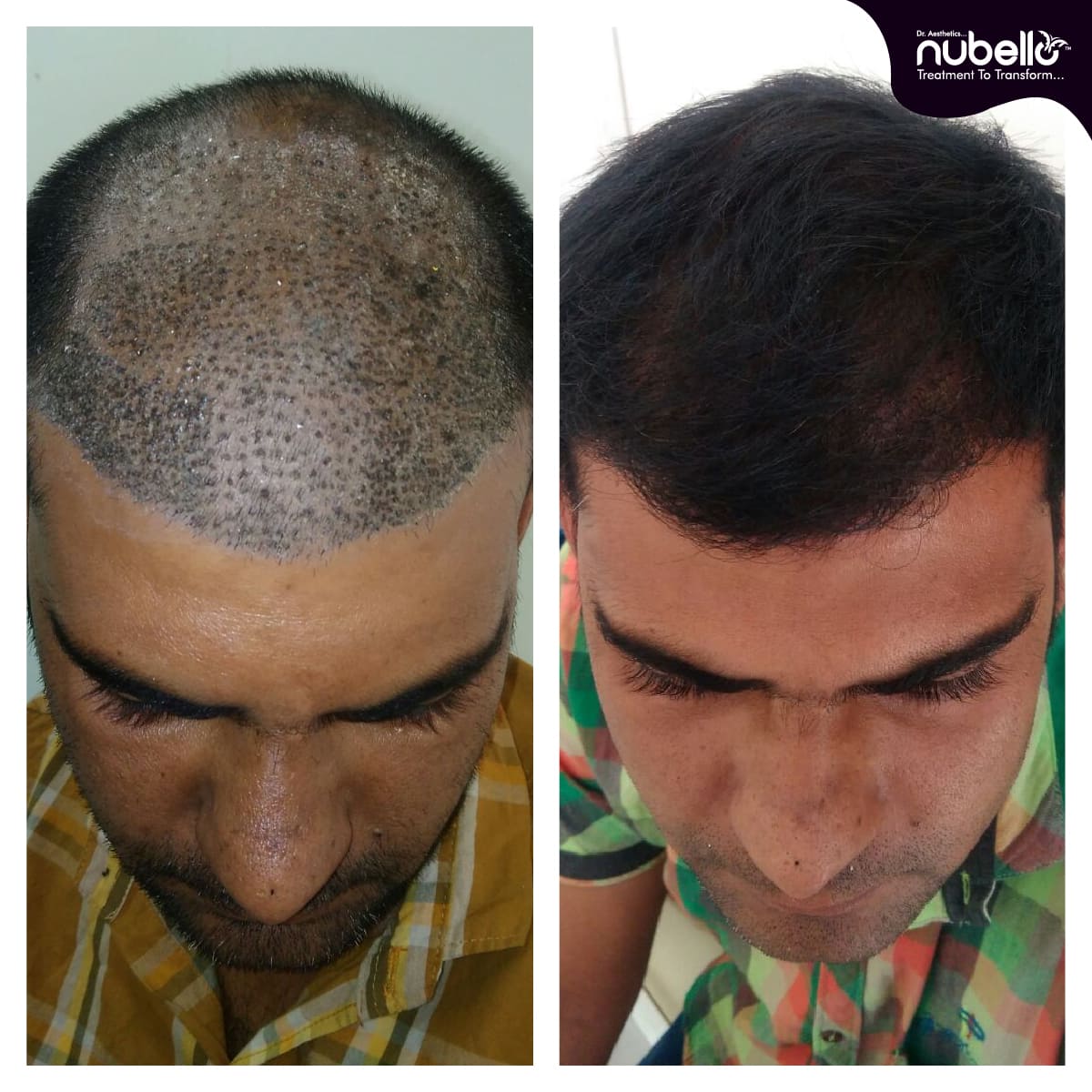 Before Hair Transplant 040