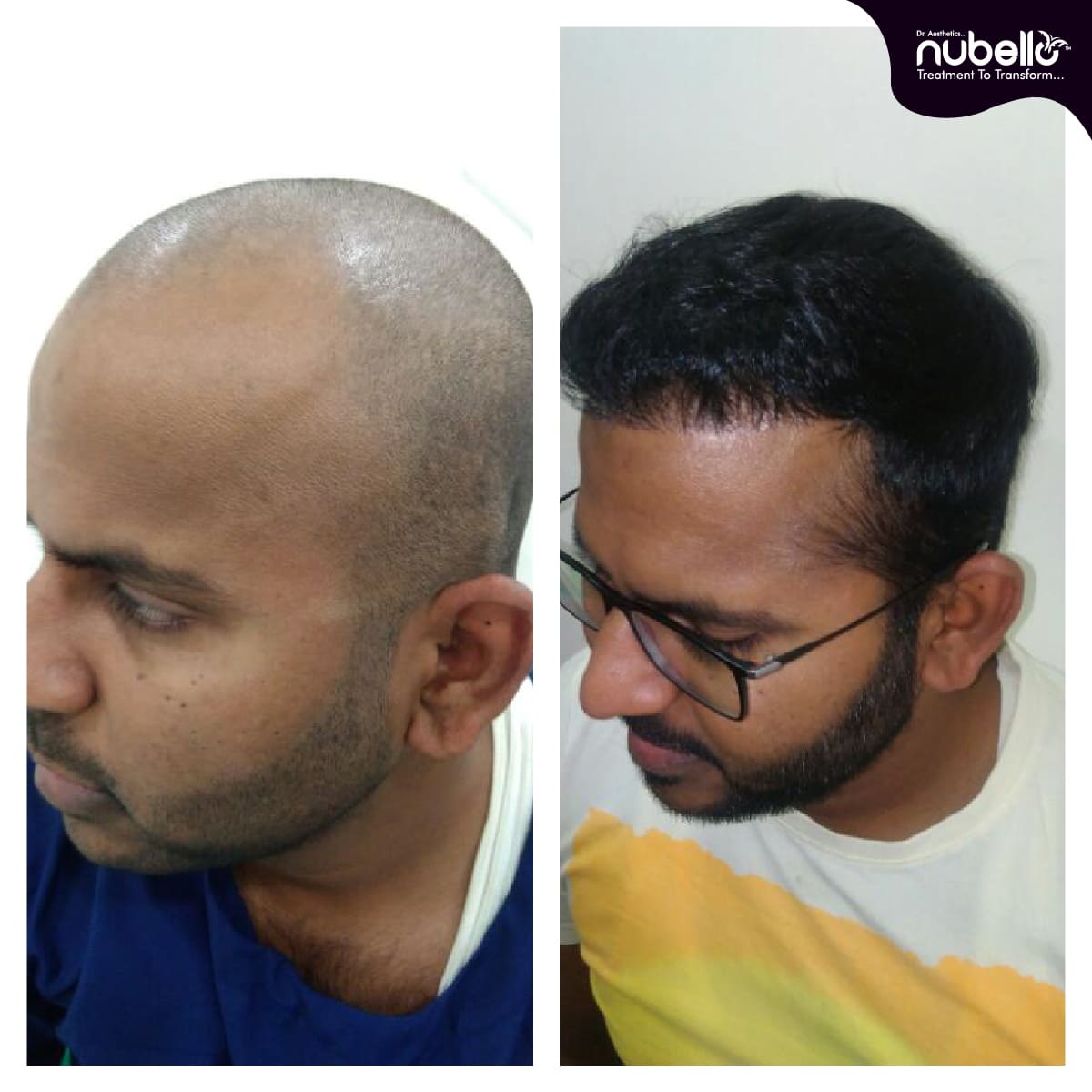 Before Hair Transplant 041